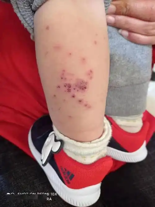 手足口病可防,可治,不可怕