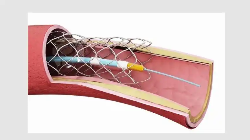心脏支架术后应该怎样护理