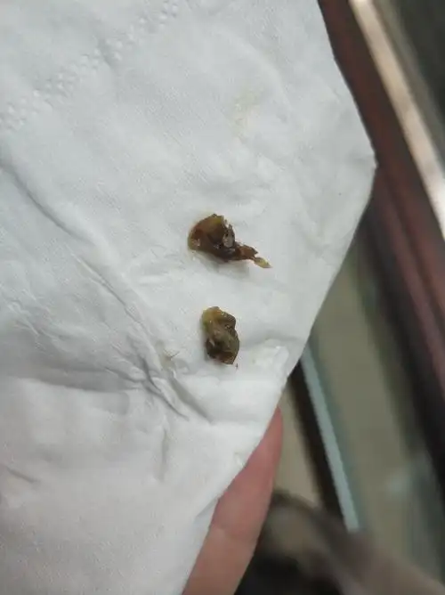 人的鼻屎能大到什么程度