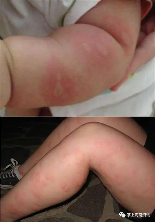 被蚊子叮咬用这个止痒千万要注意一个女孩的头差点