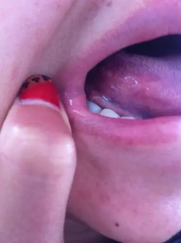 舌头两侧长的这个有一个月了,不疼不痒的