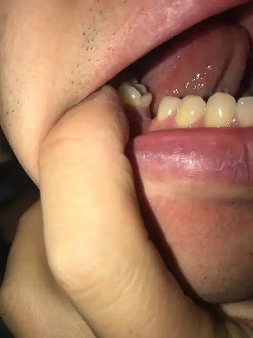 下面的臼齿拔掉好多年了一直没有种感觉上面的牙越长越大最近