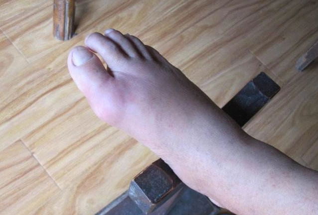 年轻人经常应酬,经常吃大鱼大肉,经常吃一些高嘌呤食物,这些食物会