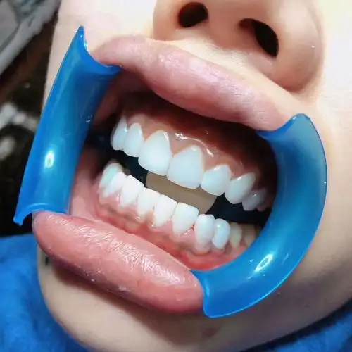 牙科材料弓形开口器m型带镜一次性扩口器美牙挡舌撑口器现货供应