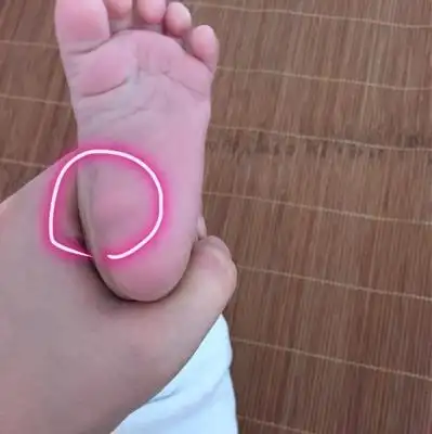 宝宝的脚底板生下来就有这样一样圆圆的鼓起来的肉球,是什麼情况?