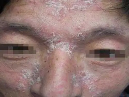头部银屑病初期图片