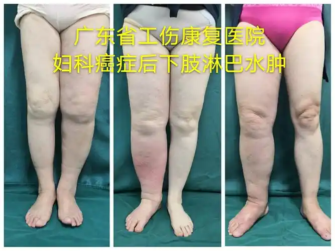 盆腔和腹股沟淋巴结清扫术与淋巴水肿的发生直接相关,在下肢淋巴水肿