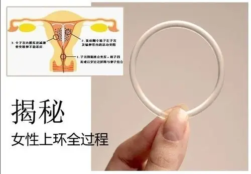 > 西安哪些情况需要取环     (4)绝经半年以上已经失去生育能力的妇女