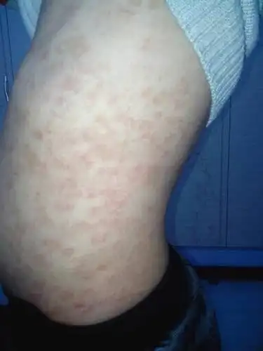 这是梅瑰康疹吗?怎么治疗啊