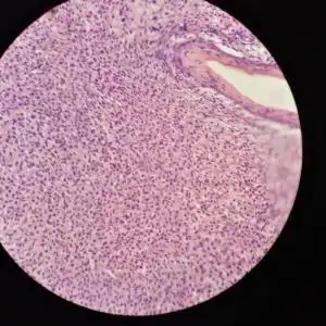 各位老师帮看看精索囊肿1岁囊壁因睾丸鞘膜积液手术发现