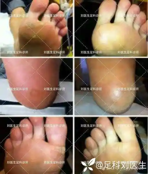 针刺可以治疗跖疣?你可能真的没见过!(文献及手把手治疗视频)