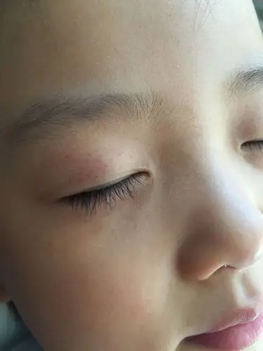 孩子三岁多,女孩,今天发现眼睛周围长了好多小红点,左右眼都是,请问咋
