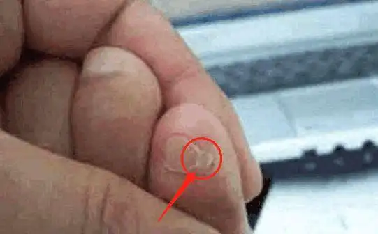 纯种汉人的小脚趾上真的有两瓣甲吗西方医学界将其定义为病变