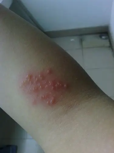 胳膊上起水泡了,求医生帮我看看这是什么情况……有