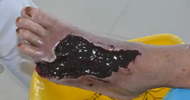 糖尿病足伤口不愈合,攻破以下三个因素,真的可以保守不截肢