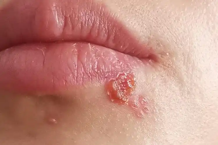 唇疱疹