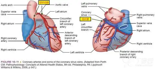 就是将导管放在冠状窦这里,往里灌,逆着从静脉→冠状动脉,使得心肌停