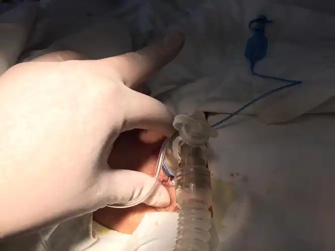 床边气管切开术如何做到完美?