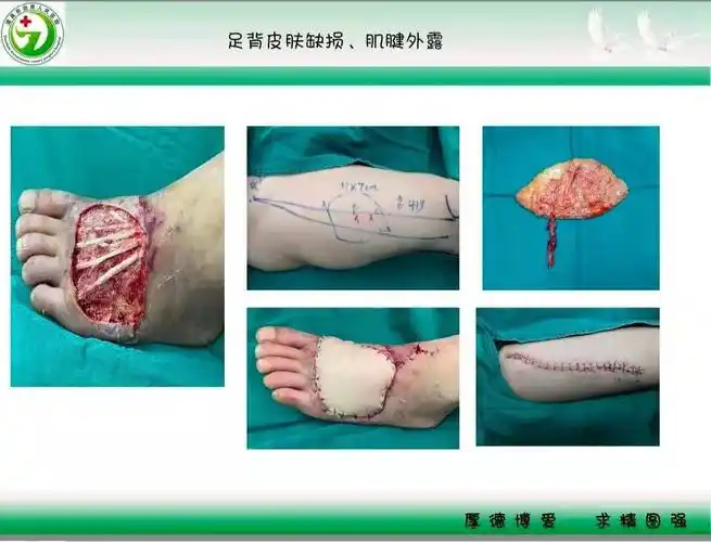 道真县人民医院骨科——皮瓣移植术