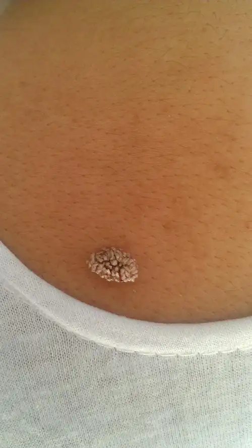 皮肤上长了小疙瘩,有很多小瓣