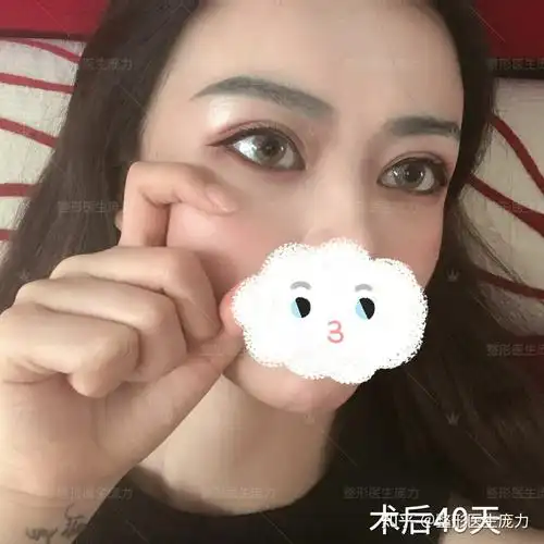 仿生态双眼皮开内眼角术后恢复过程