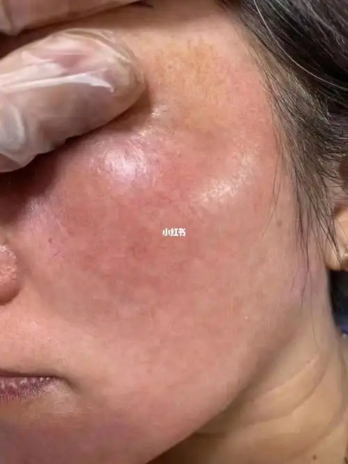 剥脱类提取类的美白祛斑就是这种样子 表皮全被剥脱了,毫无抵抗力!没