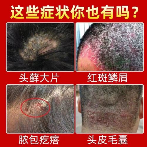 头皮癣专用药膏治疗头部牛皮癣银屑藓头屑头痒真菌感染特效止痒膏