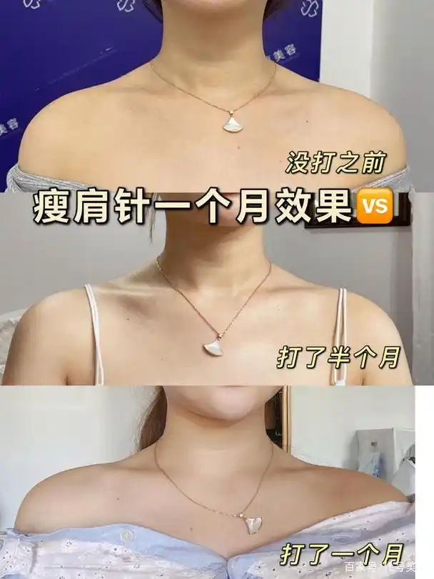 瘦肩针一个月效果,肩膀变薄了