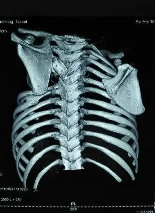 先天性高肩胛症除表现患侧肩胛骨位置高以外,还表现为上肢的外展,上举