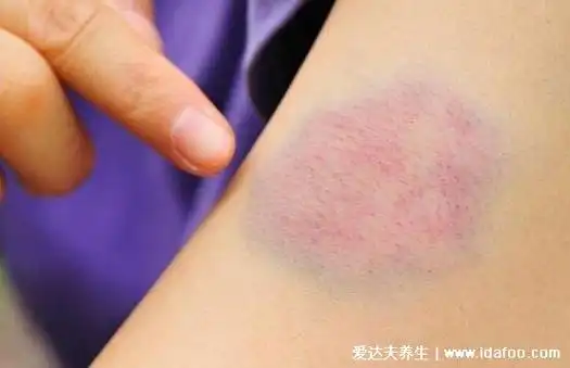 白血病的早期症状和前兆图片,多为红紫色小血点(附自查方法)