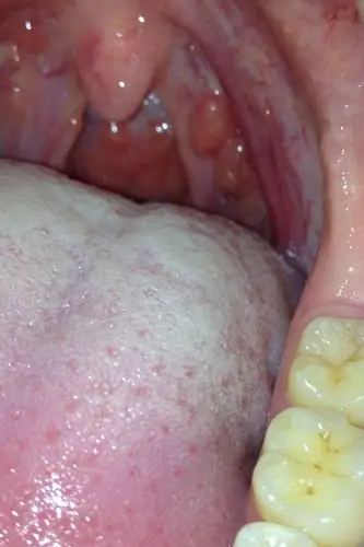 请问口腔内壁上那些突起肿块是什么看的话