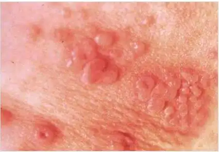 8种重点防治的性病之了解生殖器疱疹-精准抗艾-互联网艾滋病性病预防