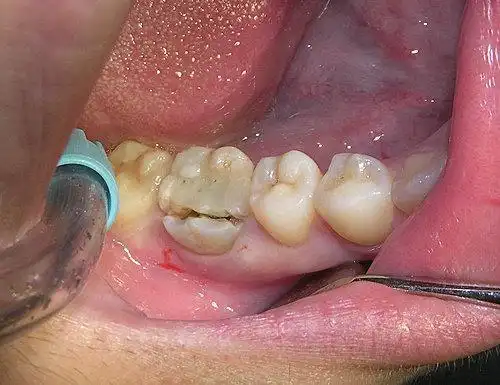 佛山中大口腔牙隐裂藏在嘴里生活中随时都可能咬爆牙齿