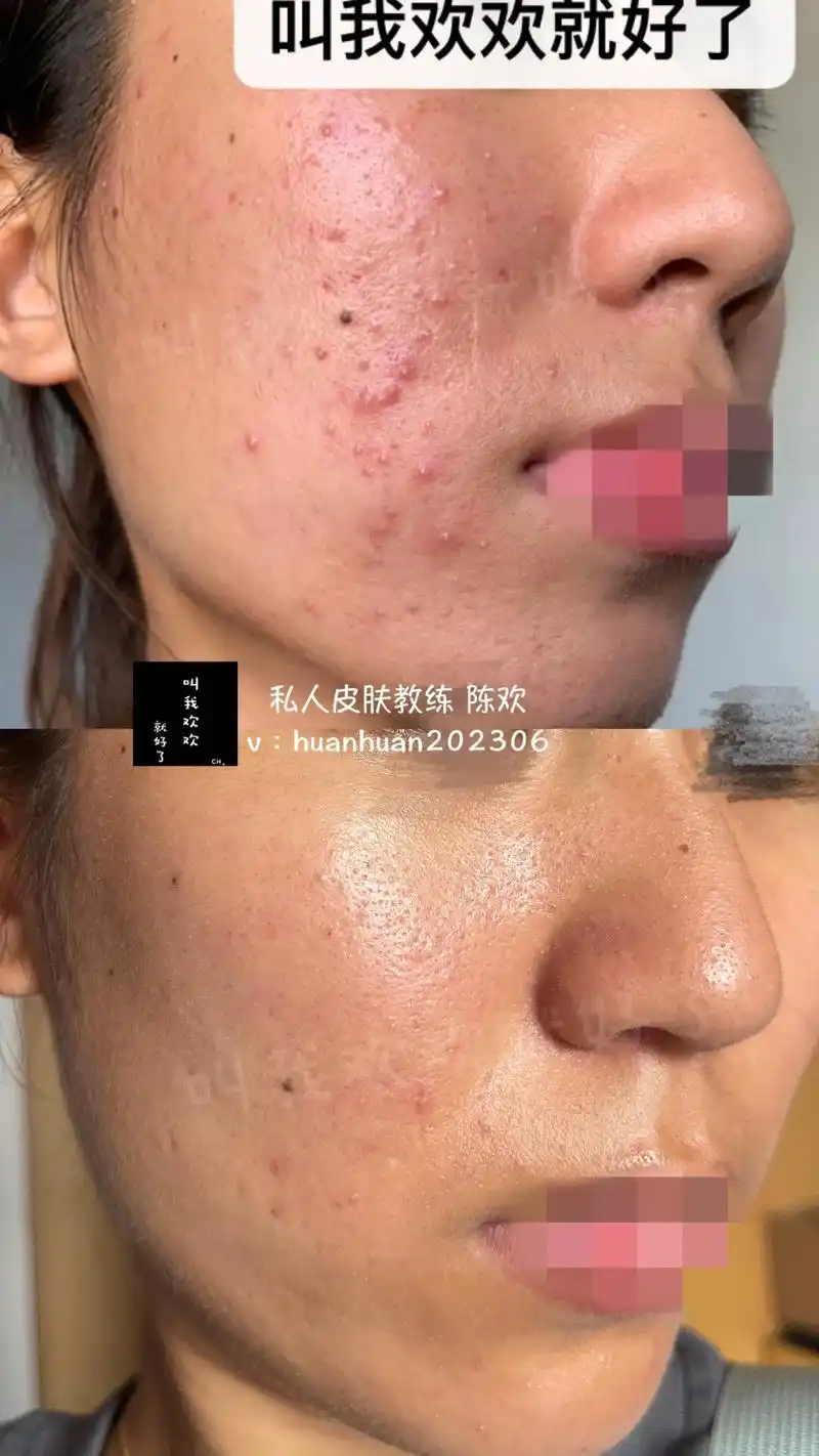 屏障受损型痘肌案例.坐标:云南边境 年龄:98 年 肤质判断 - 抖音