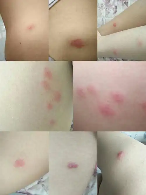 这是荨麻疹吗 还是被虫子咬的 这两天突然起的很痒