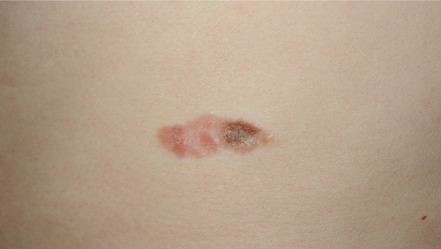 侵袭性鳞状细胞癌诊断:鳞状细胞癌的诊断需要依靠皮肤活检病理.