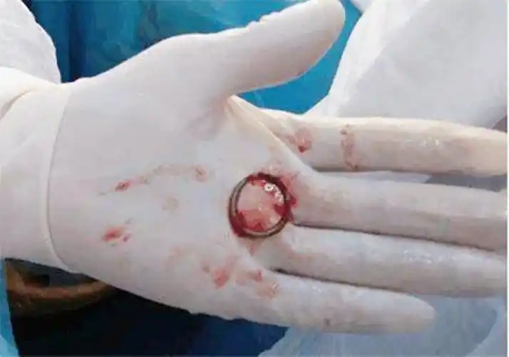 原创因为怕疼30年未取节育环去医院做手术医生想取也取不了了