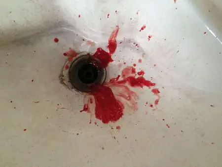 感觉有什么东西呛到 去厕所咳就咳血了 马上去医院 急诊给我查了痰和