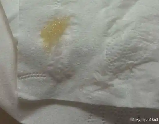 简要病史:女,40 岁,痰呈果冻状 1 周.