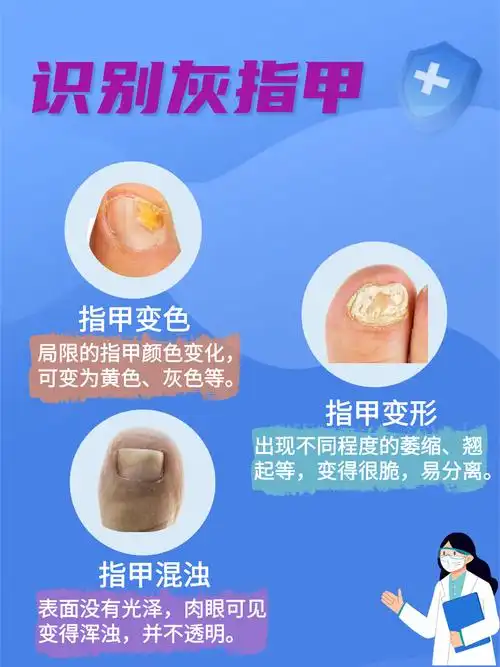 一分钟识别灰指甲,快快码下来!