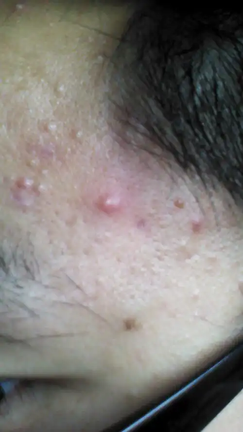 有没有好的消除方法?(附图片)