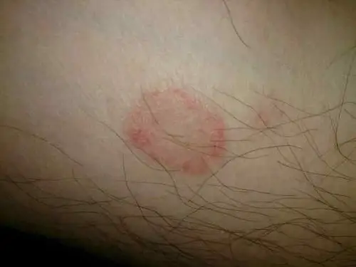 皮肤上红斑是什么?