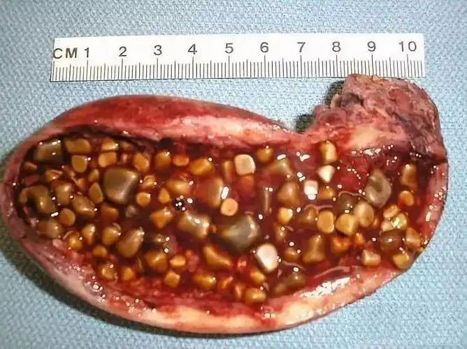 56岁长出2980颗肾结石她的问题很多人都有再不注意就晚了