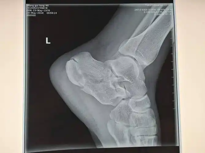 足跟骨骨折