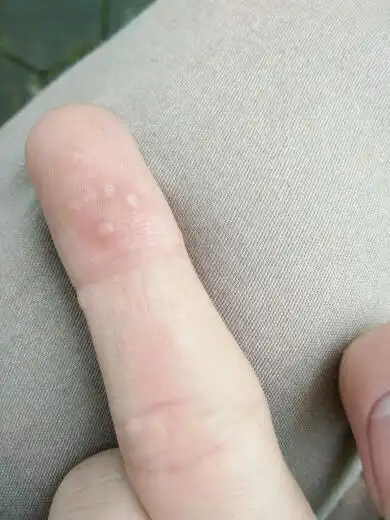 在手指上而且长得很快,好像硬硬的白色的死皮会繁殖的,本来一颗现在