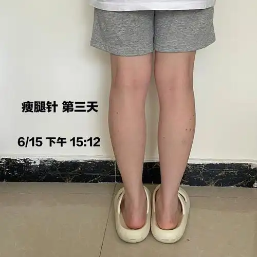 第三天感觉小腿有点肿肿的 走路的无力感没有头一天强烈第四天走路
