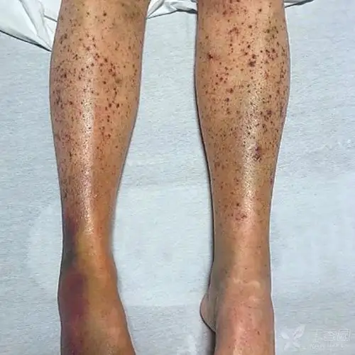 视如诊宝:坏血病皮肤瘀点瘀斑 [病例帖]