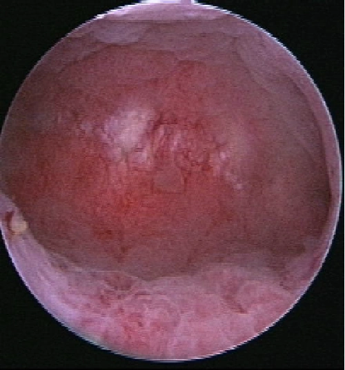 宫腔镜下的子宫内膜炎是啥样的