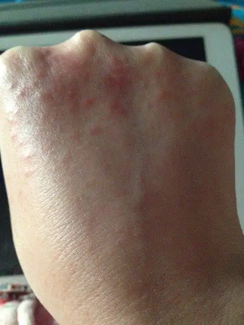 手上长了类似过敏的东西,有点痒,帮忙看看是什么?能用什么药?