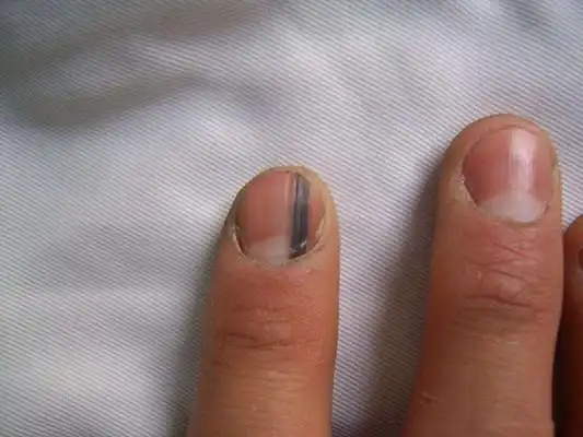 甲母痣早期图片 (32)_有来医生